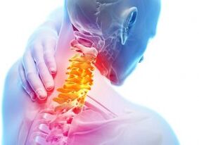 Pain and shelters in the cervical zone with third degree of osteochondrosis