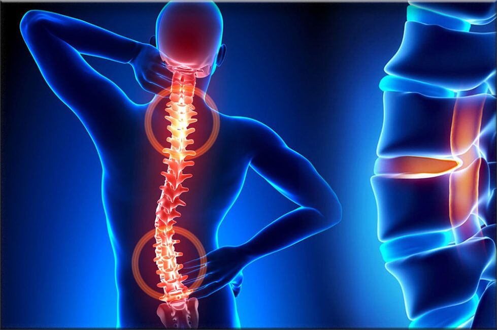 The spine is osteocondritis